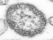 Measles can compromise eyesight